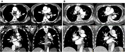 Seizure as the clinical presentation of massive pulmonary embolism: Case report and literature review